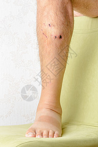 痛被狗咬伤的人腿部受尖牙留下的深处伤口很明显皮肤感染图片