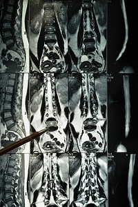 疾病解剖学脊柱X光薄膜上线的人体子宫颈磁共振成像医生图片