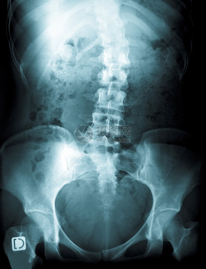 一个年轻女性脊椎X光片图片
