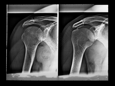 X射线骨骼诊断肩膀x光医疗x射线射线背景图片