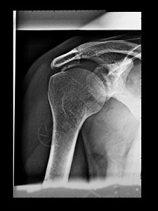 X射线骨骼肩膀医疗x光诊断射线x射线背景图片