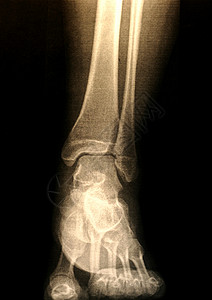 脚X光医疗放射科解剖学x光身体x射线背景图片