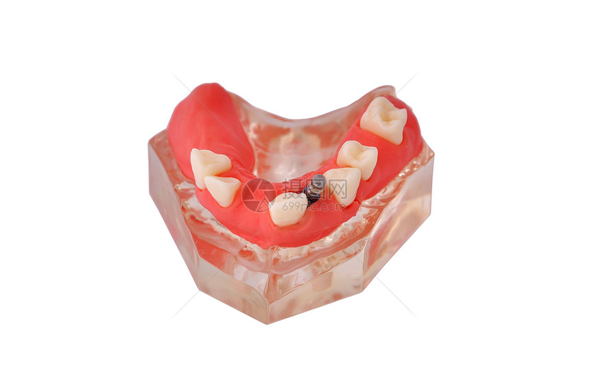 有植入的下巴假肢白色牙龈牙科印象牙齿假牙图片