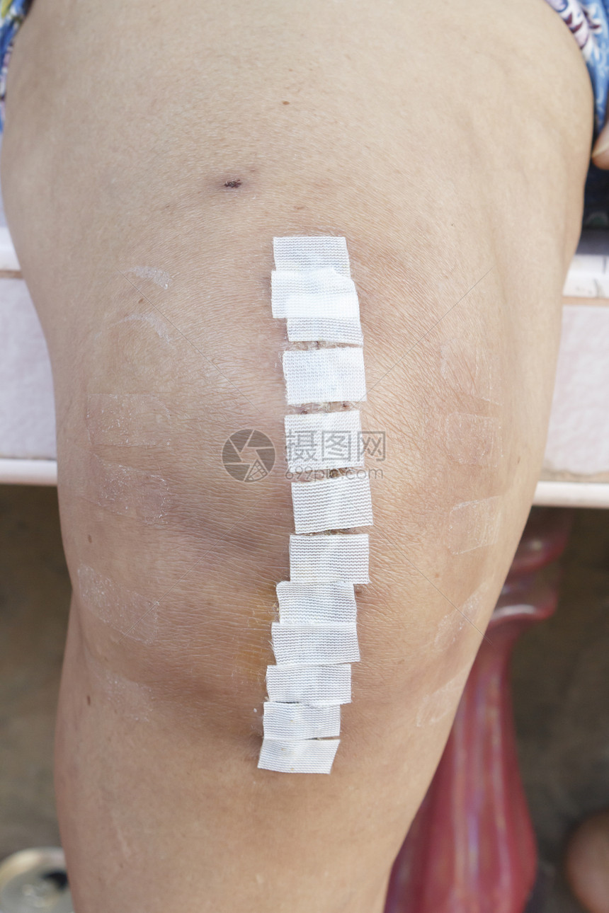 替代膝盖的切口皮肤疼痛缝线病人人体伤口身体外科医疗疾病图片