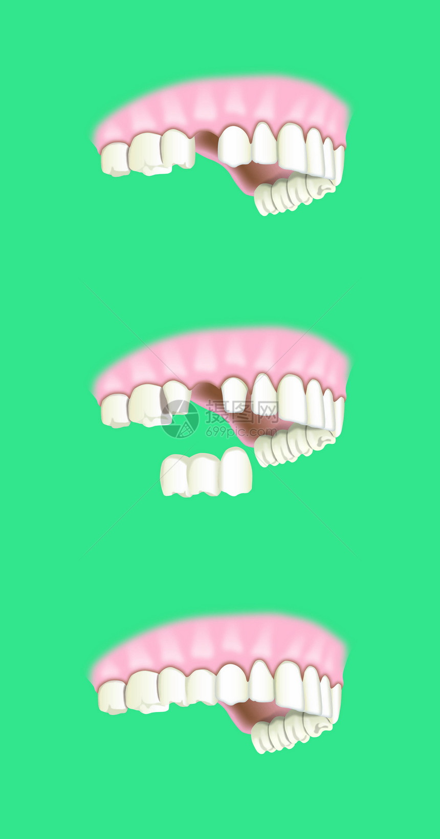 牙科假牙植入术图片