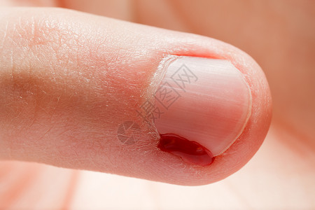 血伤口指甲援助癌症疼痛美甲身体卫生瘢痕帮助倒刺皮肤高清图片