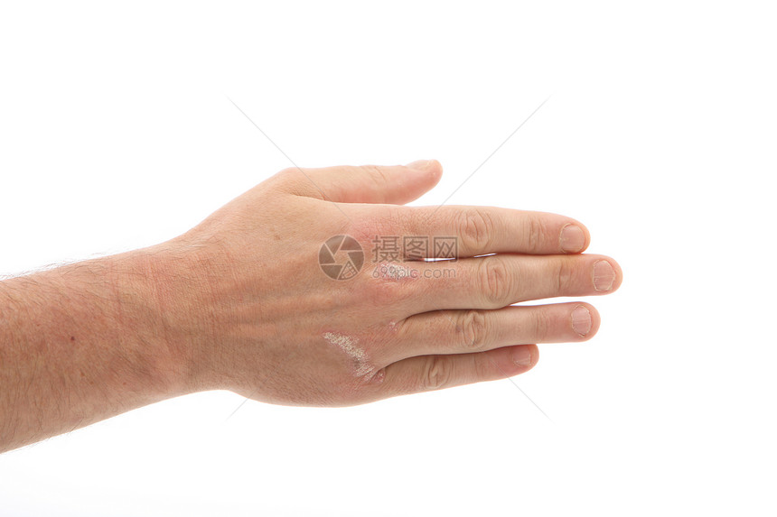 手和指甲下有丝虫病图片