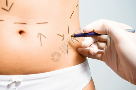 美容整形手术的腹膜标记高清图片
