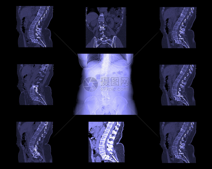 计算脊椎断层造影手术脊柱库存骨头诊断疾病照片身体铁饼髓质图片