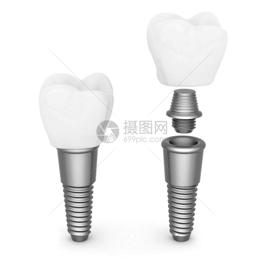 牙科移植药品医疗牙医搪瓷金属白色假牙别针插图技术图片