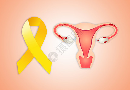 子宫颈带黄丝带的子宫内硬化背景图片