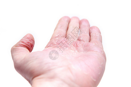 许多人的问题     手头上的湿疹 与众隔绝的背景发痒女孩痛苦身体皮肤药品过敏保健疙瘩皮肤科病人高清图片素材