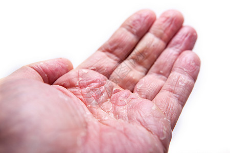 许多人的问题     手头上的湿疹 与众隔绝的背景女孩治疗皮疹感染表皮症状手指卫生皮肤科疼痛卫生保健高清图片素材
