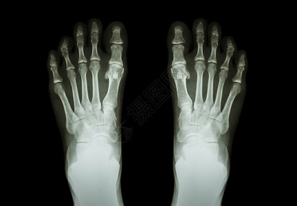 两脚影片X光前视跖骨双胞胎外科诊断骨科跗骨扫描x射线放射科x光背景图片