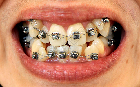 女人带着牙套微笑高清图片