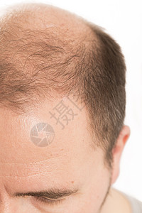 Alopecia 男人头发毛发失去理发活力发型损失胡须男性药品头皮梳子疾病治疗背景图片