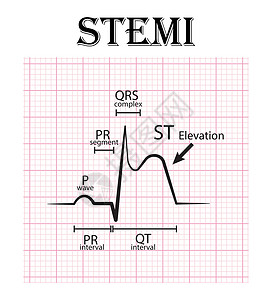 电子相册prST抬高心肌梗死心电图 STEMI心电图细节 P波 PR段 PR间期 QRS复合体 QT间期 ST抬高T波 急性冠脉综合征心绞痛插画