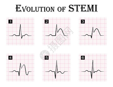 醋溜段STEMI ST段抬高心肌梗死 急性冠脉综合征心绞痛的演变 逐步 心电图插画