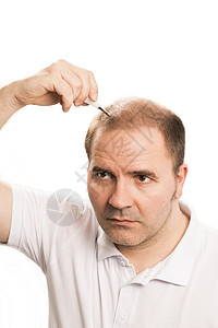Alopecia 人毛发脱落头发剪裁疾病头皮治疗男人皮肤发型胡须护理背景图片