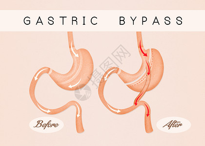 胃前及之后的绕行手术外科饮食卫生肠子减肥器官插图肥胖保健背景图片