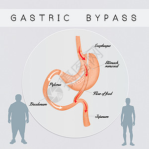 肠胃外科手术减肥男人男性肠子插图饮食肥胖器官保健卫生背景图片