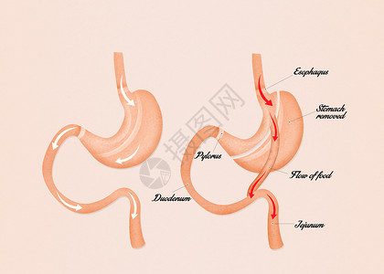 肠胃绕行外科减肥肥胖保健卫生肠子手术饮食插图器官背景图片
