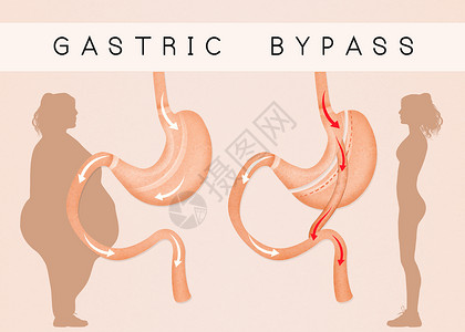 减少胃部的胃道切除术肠子外科插图饮食减肥肥胖卫生手术保健器官背景图片