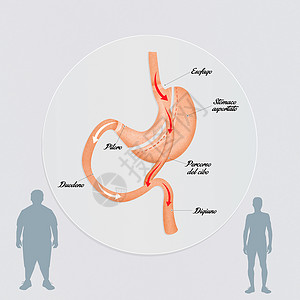 肠胃绕行卫生肥胖手术男性外科插图肠子保健减肥饮食背景图片