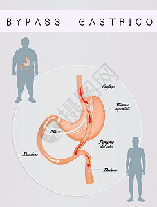 肠胃绕行器官卫生减肥插图饮食肠子手术外科男人男性背景图片