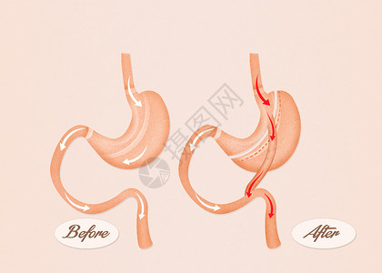 肠胃绕行手术插图饮食卫生器官肠子外科减肥保健肥胖背景图片
