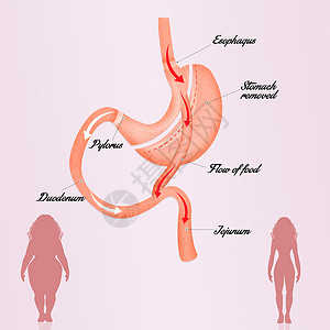 肠胃绕行保健器官卫生肥胖减肥女性饮食插图外科女士背景图片