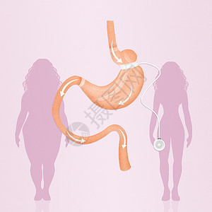 减少胃胃部的胃道带保健卫生插图肥胖手术肠子小袋器官可调减肥背景图片