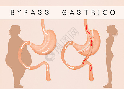 减少胃部的胃道切除术器官肥胖肠子女士保健外科饮食手术卫生插图背景图片