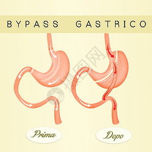 肠胃绕行保健器官肠子卫生手术饮食减肥肥胖插图外科背景图片