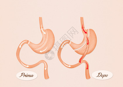 肠胃外科手术饮食器官保健减肥肥胖卫生插图肠子背景图片