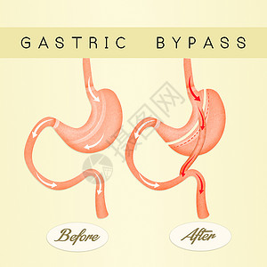 肠胃绕行饮食肠子插图减肥器官保健外科手术卫生肥胖背景图片