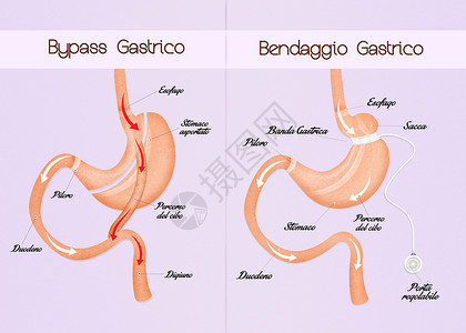肠胃绕行和腹腔带肠子减肥插图饮食小袋器官手术卫生乐队保健背景图片