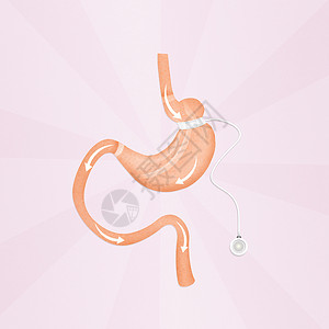 胃管外手术背景图片