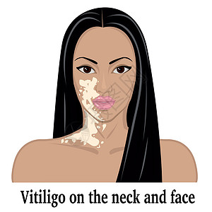 白癜风颈部和脸部的维蒂里戈设计图片
