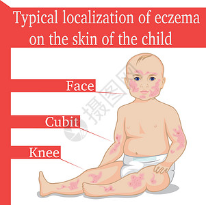 皮肤状况儿童用食血(Eczema)设计图片