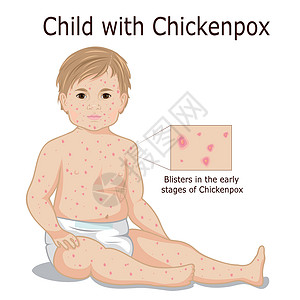 宝宝皮肤患有天花鸡的儿童插画