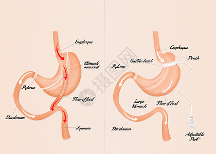 肠胃绕行和腹腔带器官乐队插图肥胖饮食卫生手术减肥肠子小袋背景图片