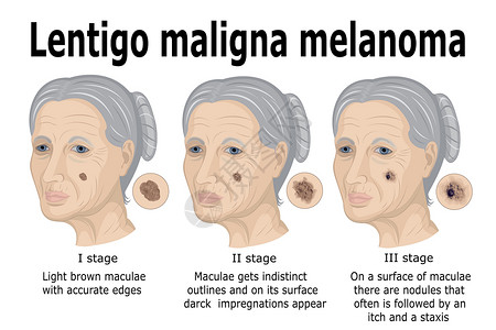 伦蒂戈恶性黑皮瘤高清图片