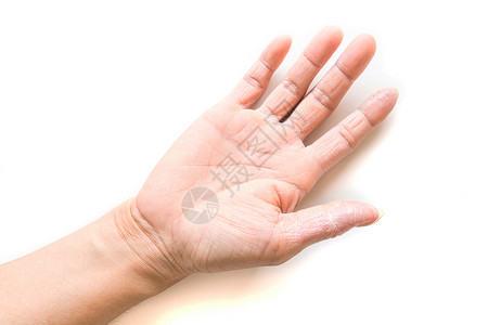 白色背景上的手感光炎症状皮肤纹理皮炎状况剥皮卫生湿疹皮疹药品疼痛过敏疾病感染高清图片素材
