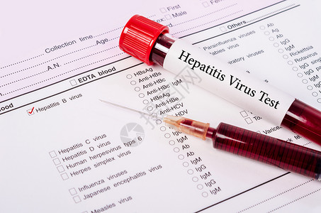 乙肝五项世界肝炎日概念病人世界科学测试实验室肝炎疾病微生物学血液学管子背景
