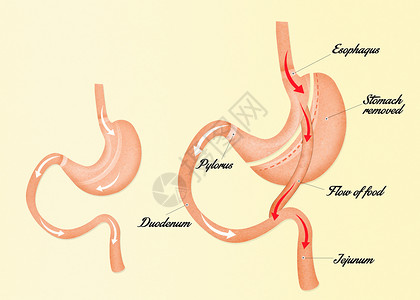 肠胃外科手术肠子保健插图卫生减肥器官饮食肥胖背景图片