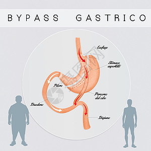肠胃外科手术男性男人卫生器官饮食肥胖减肥保健肠子插图背景图片