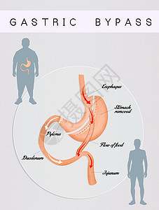 肠胃外科手术饮食卫生减肥保健肠子器官肥胖男性男人插图背景图片