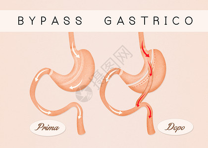 胃前及之后的绕行手术卫生插图器官外科肥胖保健减肥肠子饮食背景图片