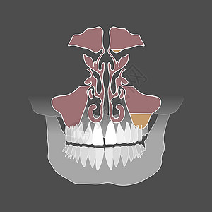 筛骨由于牙齿根根病发作 上螺旋性鼻炎激怒; 牙根根部疾病导致口腔结肠炎插画